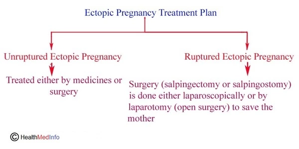 Ectopic Pregnancy Treatment Plan