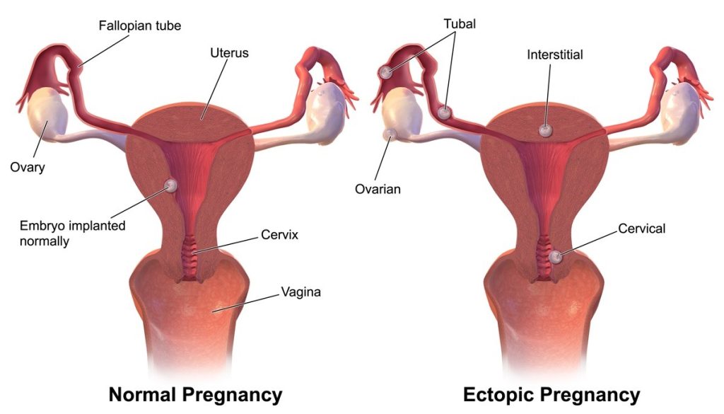 Ectopic Pregnancy Vs Normal Pregnancy